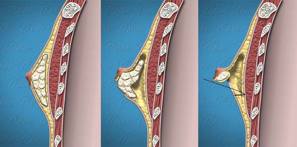 Gynecomastia surgery