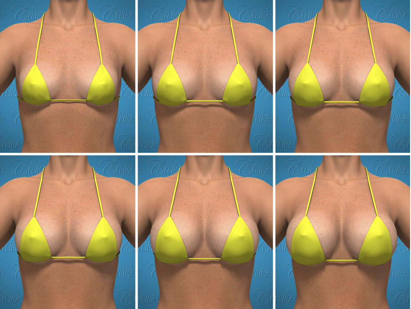 Implant variations